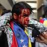 epa07315392 (FILE) - A wounded protester as thousands take to the streets during a protest against President Maduro in Caracas, Venezuela, 23 January 2019 (reissued 24 January 2019). Venezuela has fallen into a new deep political crisis after National Assembly leader Juan Guaido declared himself interim president of Venezuela 23 January and promised to guide the country toward new election as he consider last May's election not valid. Many Heads of State and governments have recognized Guaido as president, among them US President Donald Trump, Canadian Government and Brazil President Jair Bolsonaro. Nicolas Maduro became president in 2013 after the death of Hugo Chavez and was sworn in for a second term on May 2018. Venezuela has been facing an economic and social crisis where the inflation, according to the document of the National Assembly, has reached 80.000 per cent per cent in 12 months and the shortages of basic items have lead millions of people into poverty while according to reports up to three million Venezuelans have left the country since 2014.  EPA-EFE/MIGUEL GUTIERREZ