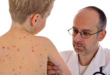 Eпидемија на мали сипаници во Дебарско