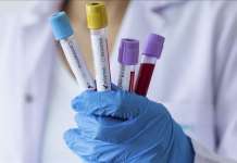 Нови 162 случаи на ковид-19 во земјава, починаа девет лица