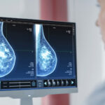 Развиена вештачка интелигенција го открива ракот на дојка години пред да се развие