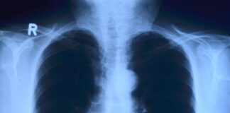 Тест на крвта клучен за откривање рак на белите дробови